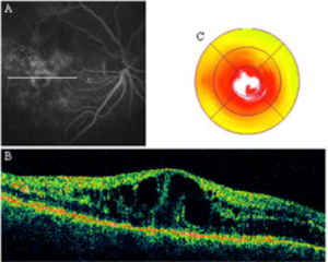 RETINOPATIA DIABETICA